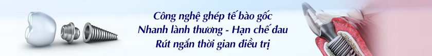Cấy ghép răng implant toàn hàm