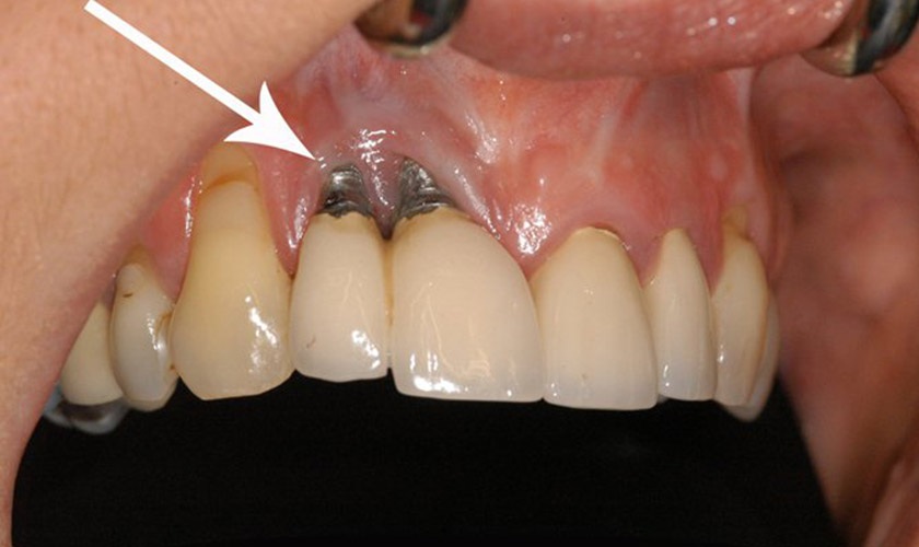 Biến chứng sau cấy Implant có nguy hiểm không? Giải giải khắc phục là gì?