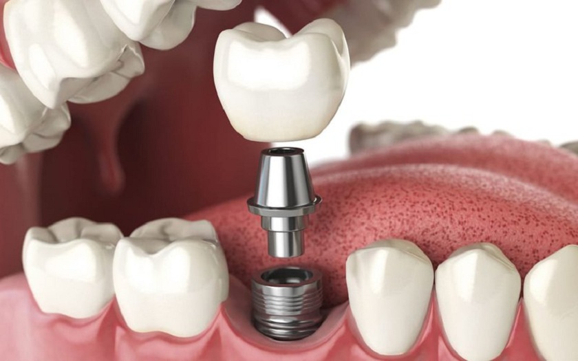 Ưu điểm và nhược điểm của cấy implant